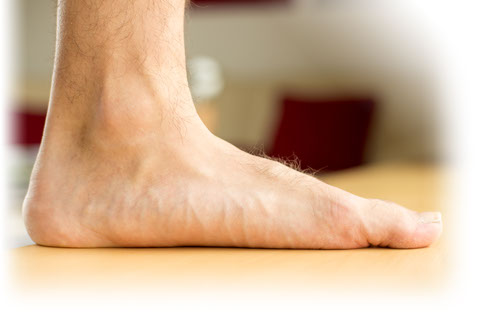 flat foot